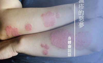 Soooradio 基督教廣播電台 身體會說話（05）-濕疹的惡夢